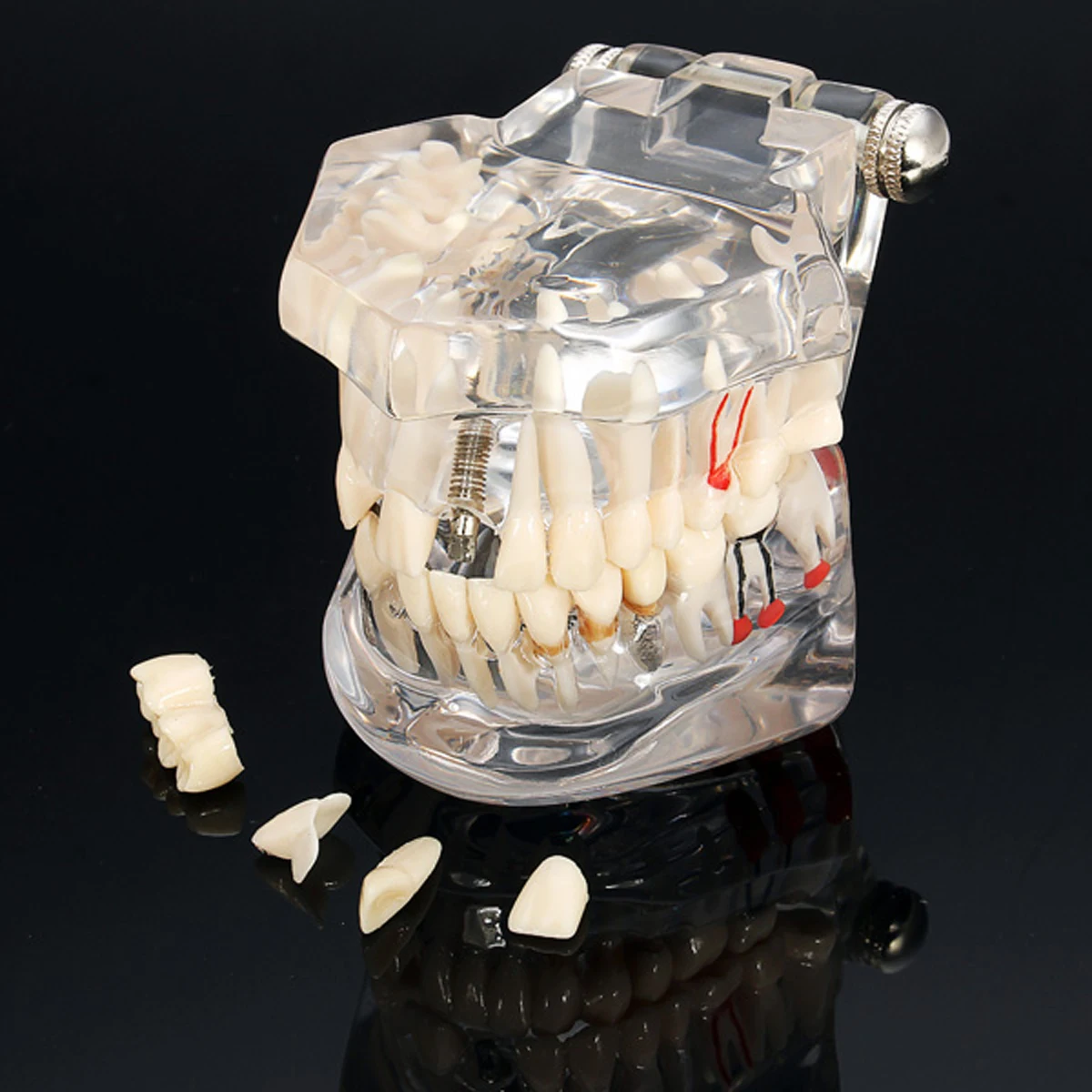 Dantų Implantai Dantų Ligos Modelis Su Restauravimo Tiltas Dantų Odontologas Medicinos Mokslo Dantų Ligos Mokymo Studijų Įrankis