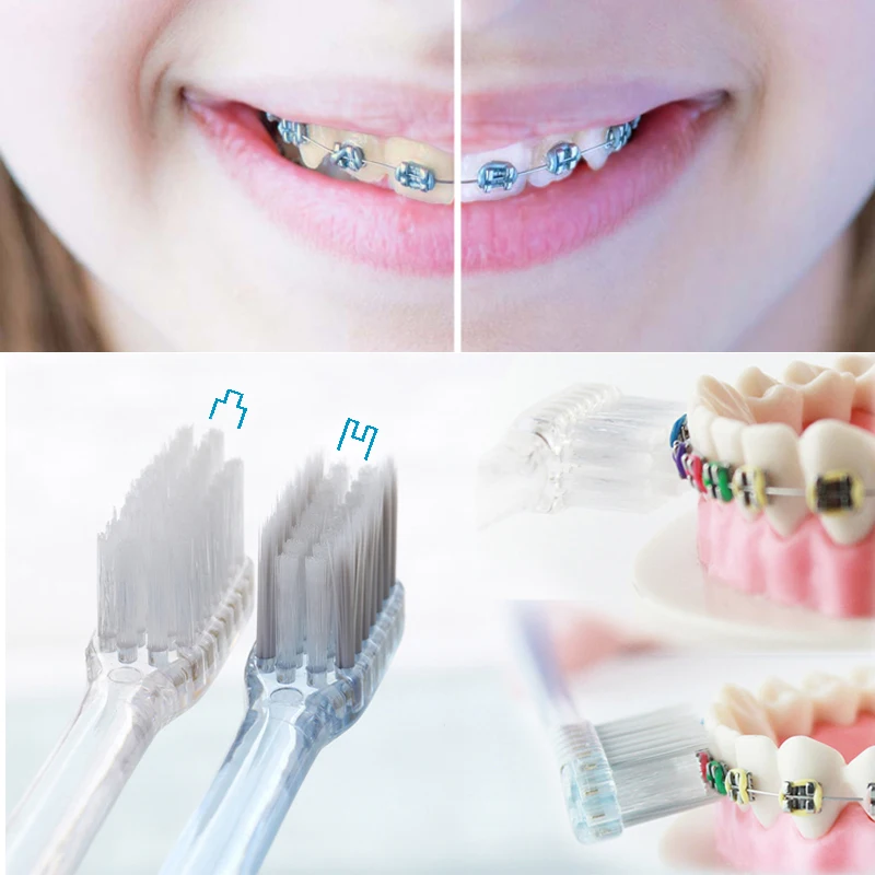 Ortodontinis dantų Šepetėlis DuPont Šereliai ir Antibakterinių Minkšti Šeriai su Sidabro Jonais Įgaubtas & Cilindro 2 Vnt/Komplektas