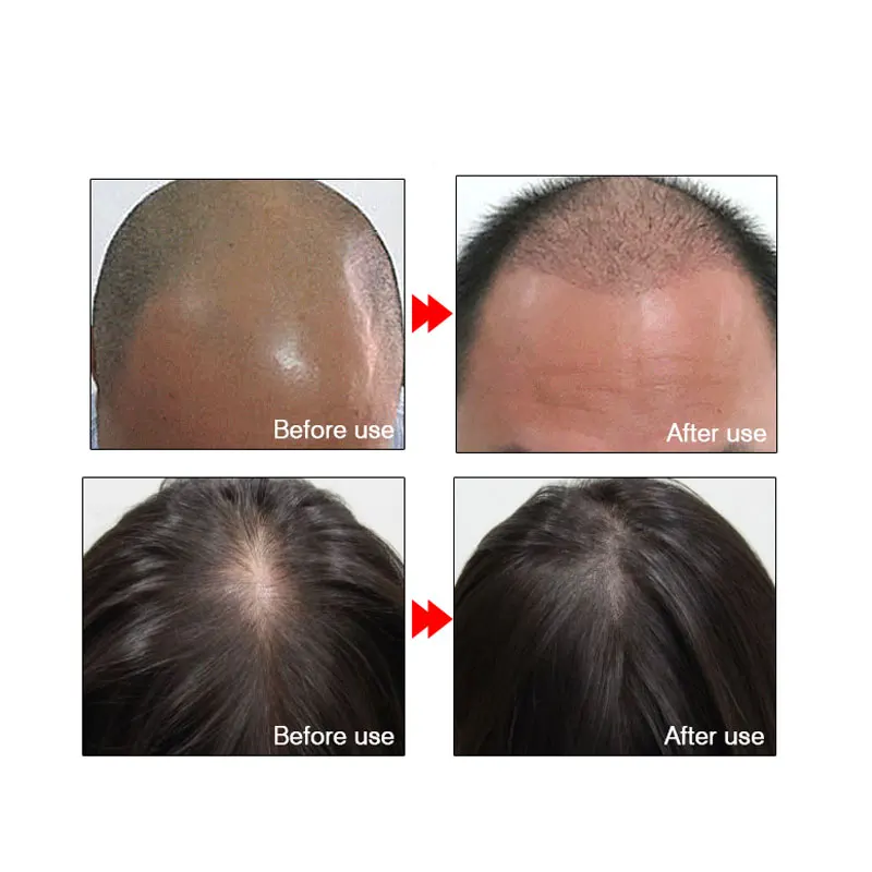 ARTISCARE Plaukų Augimo Esmė Plaukų Augimą Produktų eterinis Aliejus Skystas Gydymo užkirsti Kelią Plaukų Slinkimas, Plaukų Priežiūros Andrea 20ml2PCS